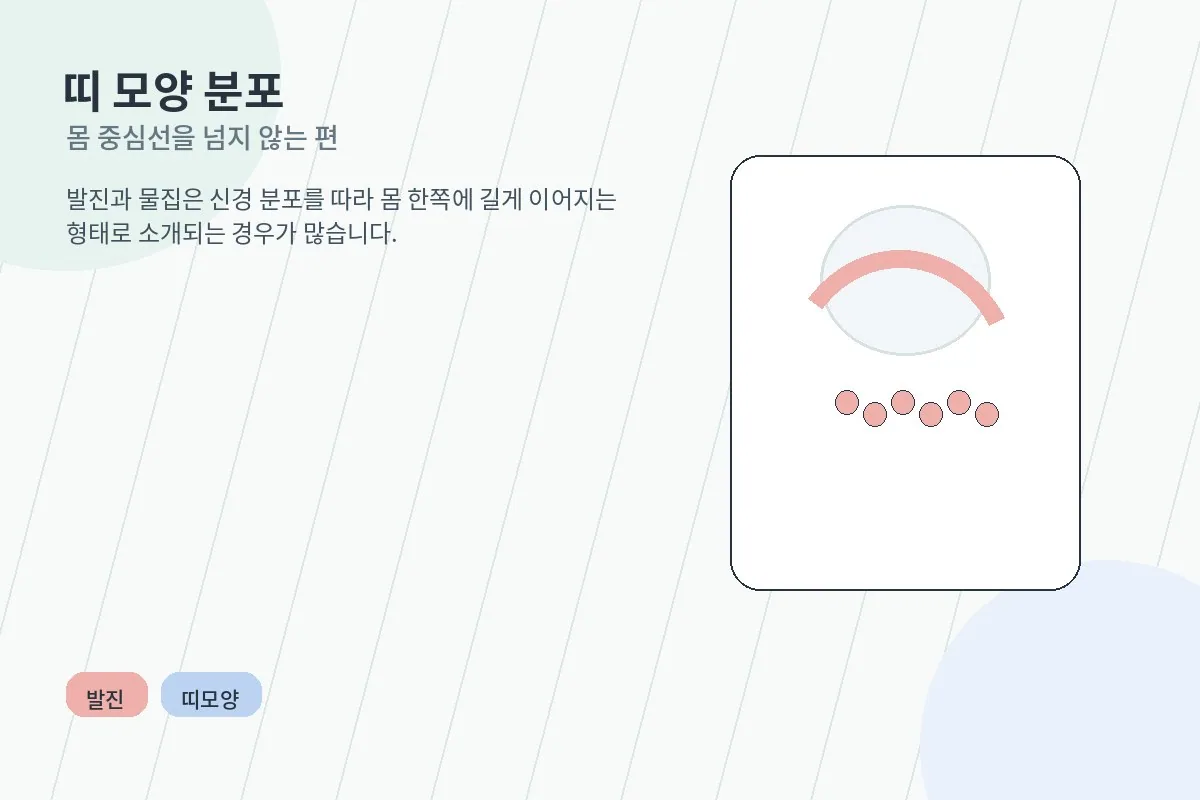 띠 모양 발진 분포를 설명하는 안내 이미지