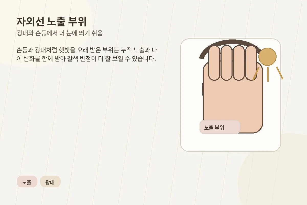 광대와 손등처럼 자외선 노출이 많은 부위를 설명하는 이미지