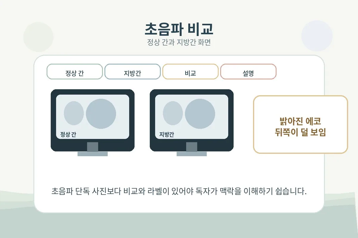 정상 간 초음파와 지방간 초음파의 차이를 비교한 설명 이미지